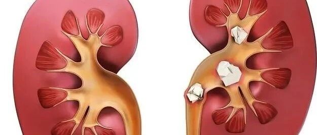 急腹症之一（输尿管结石）